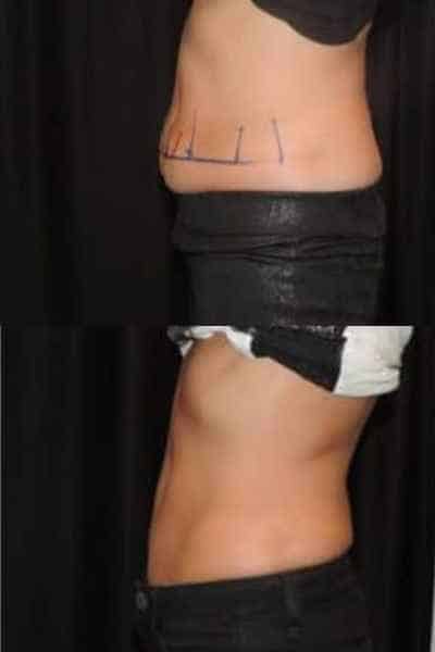 HIEMT Muscle Toning Wivenhoe
