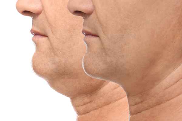 HIFU - Breakthrough in Anti - ageing 2 hifu results Wivenhoe