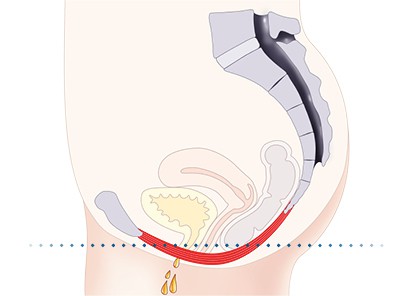 Pelvic-Floor Muscle Repair 5 Pelvic floor muscles Wivenhoe