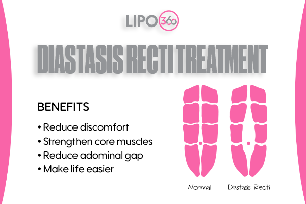 Revolutionising Muscle Repair: The Power of LIPO360 Body Sculpt Post-Injury 5 diastasis recti treatment Wivenhoe