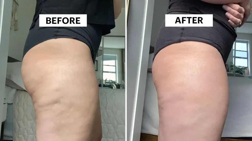 Sculpting Your Bum: Can Toning Exercises Really Reduce Cellulite? 1 Do Toning Exercise Wivenhoe Really Tackle Cellulite?