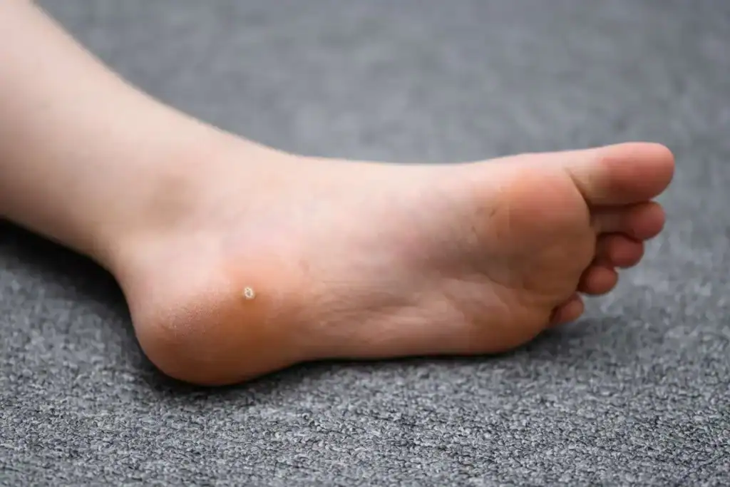 Cryotherapy For Warts And Also Verrucas 2 Image of verruca on the bottom of the foot that able to be treated with Cryotherapy Wivenhoe