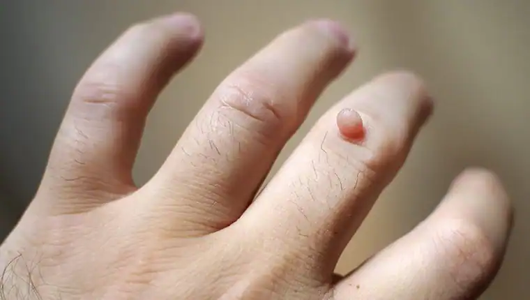 Cryotherapy For Warts And Also Verrucas 1 Image of blemish that Cryotherapy Wivenhoe can remove with Lipo 360.