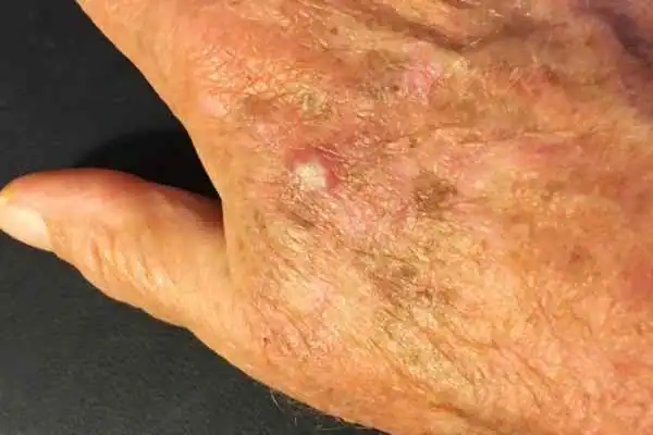 Cryopen For Actinic Keratoses 1 Image of Actinic keratoses Wivenhoe on a person hand