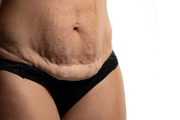 The Science of Skin Tightening 1 The science behind skin tightening Wivenhoe picture of a woman's sagging skin on the stomach